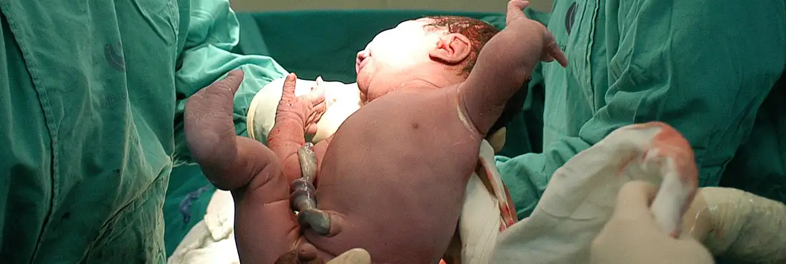 A doação de sangue do cordão umbilical amplia as chances de compatibilidade para quem necessita de um transplante