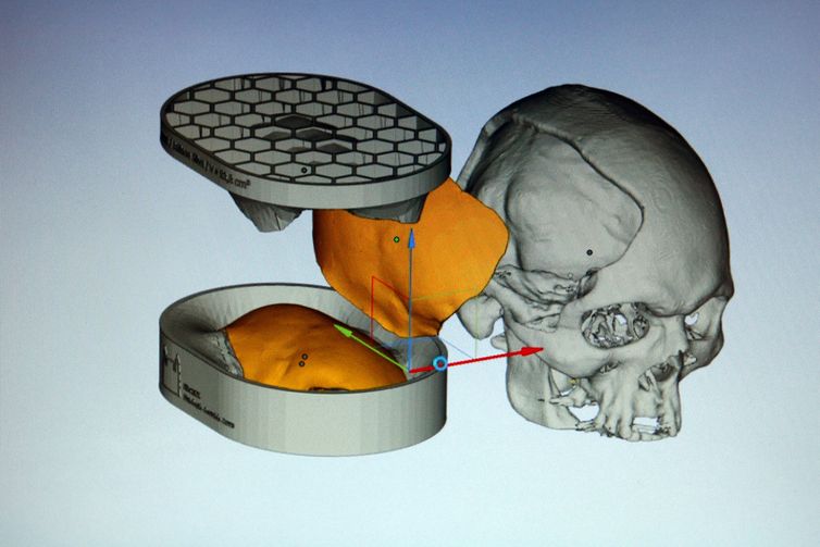  Reprodução de imagem de computador apresenta molde e colocação de prótese de cimento ósseo desenvolvida com tecnologia de custos reduzidos por equipe multidisciplinar da Fiocruz, para reconstrução craniana.