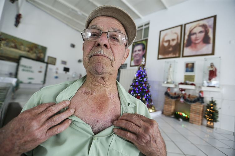 Joaquim Pedro de Menezes mostra cicatrizes de cirurgia espiritual para cura de um câncer na garganta realizada por João de Deus na Casa Dom Inácio Loyola, em Abadiânia.