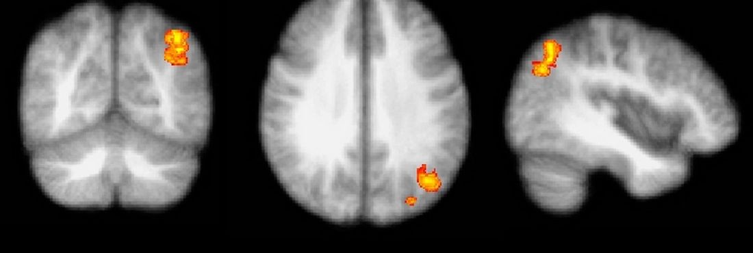Exames de ressonância magnética funcional Exames de ressonância magnética funcional de portadores de tontura refratária ao tratamento sugerem atividade exacerbada nas vias cerebrais relacionadas com ansiedade e medo