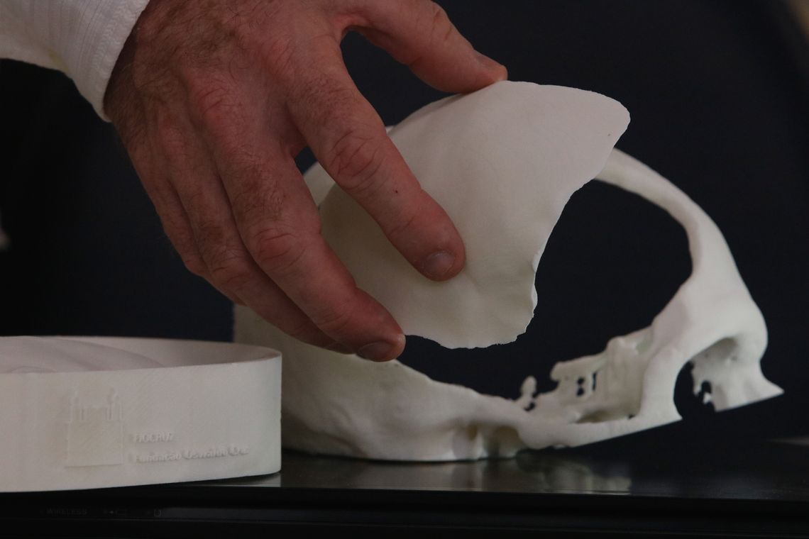  Molde e prótese de cimento ósseo para reconstrução craniana desenvolvida com tecnologia de custos reduzidos por equipe de pesquisadores multidisciplinar da Fiocruz