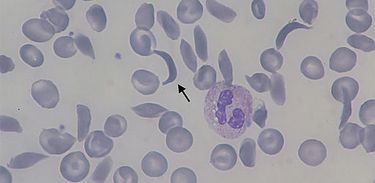 Hemácias falciformes encontrados na anemia falciforme 