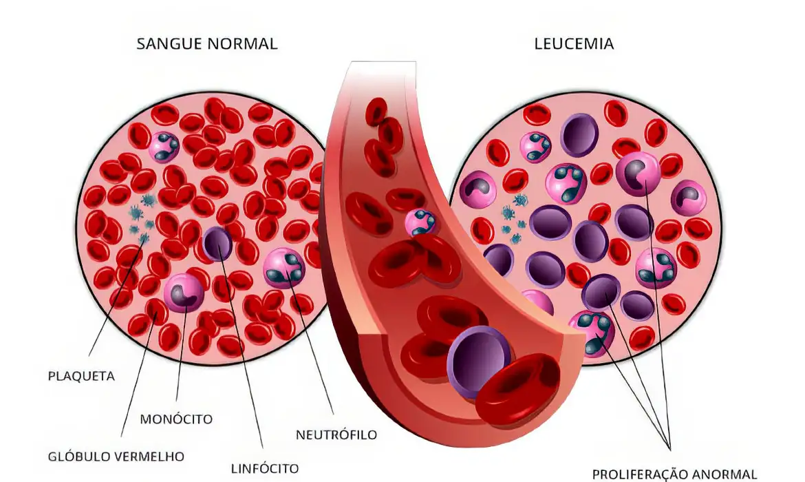 Anvisa autoriza pesquisa em pacientes com leucemia linfoide aguda B. Arte: Pfizer