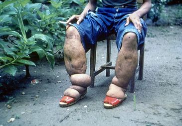 Pessoa doente que desenvolveu elefantíase, com as pernas inchadas