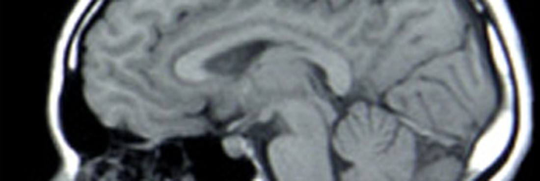 Microcefalia