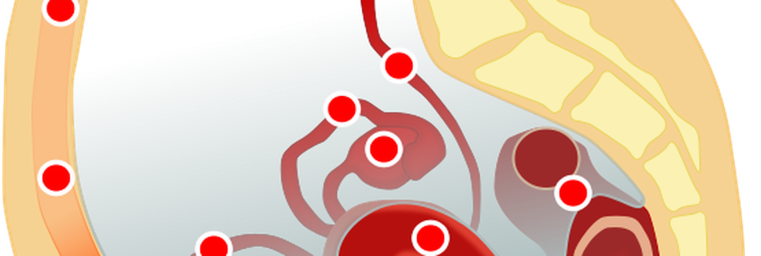 Endometriose Áreas mais comuns de serem atingidas pela endometriose