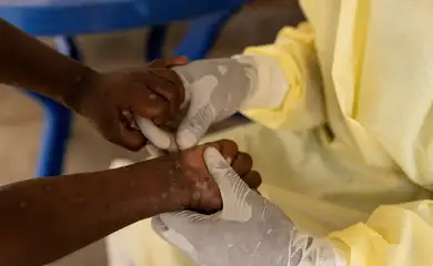 FILE PHOTO: Christian Musema, a laboratory nurse, takes a sample from a child declared a suspected case of Mpox  at the treatment centre in Munigi, following Mpox cases in Nyiragongo territory near Goma, North Kivu province, Democratic Republic of the Congo July 19, 2024. Reuters/Arlette Bashizi/Proibida reprodução