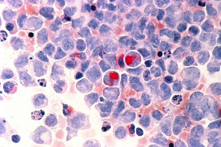 Câncer de células do sangue, Leucemia
