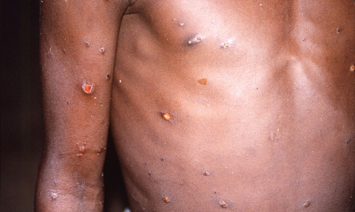 Paciente com lesões na pele provocadas pela varíola do macaco, na República Democrática do Congo