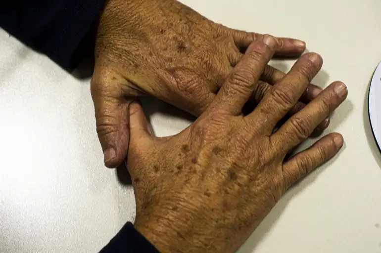 câncer de pele, melanoma