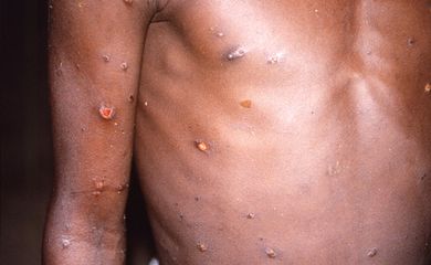 Paciente com lesões na pele provocadas pela varíola do macaco, na República Democrática do Congo