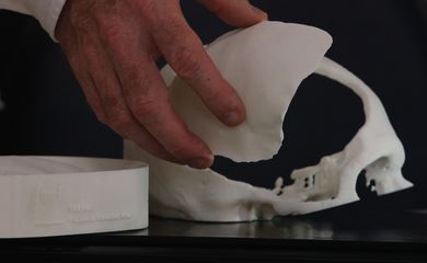  Molde e prótese de cimento ósseo para reconstrução craniana desenvolvida com tecnologia de custos reduzidos por equipe de pesquisadores multidisciplinar da Fiocruz