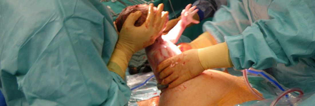 Cirurgia cesariana Brasil é o país campeão de cesarianas