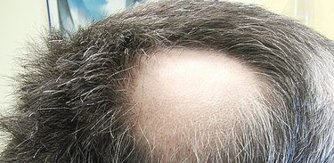 Alopecia, doença que provoca queda de pelos
