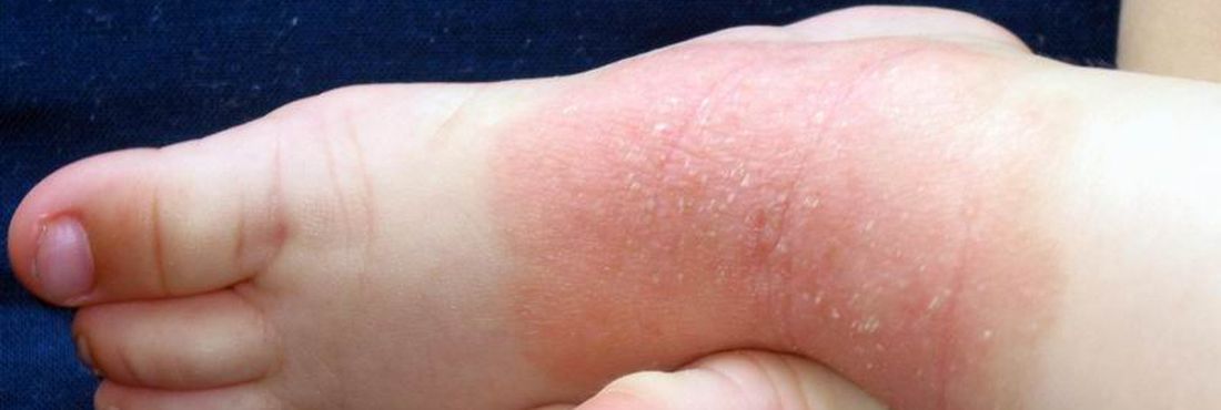 Alergia na pele