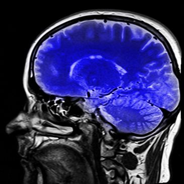 O aneurisma cerebral é a dilatação anormal de uma artéria que irriga o cérebro