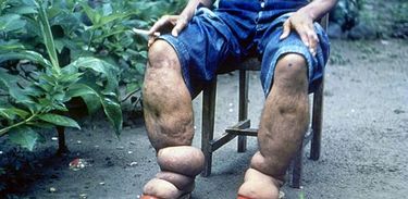 Pessoa doente que desenvolveu elefantíase, com as pernas inchadas