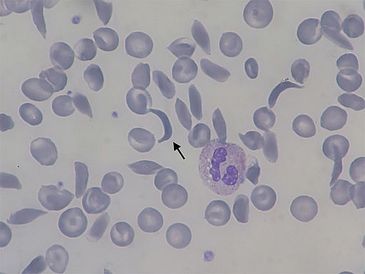 Hemácias falciformes encontrados na anemia falciforme 