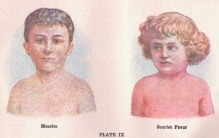 Ilustração de crianças com sarampo