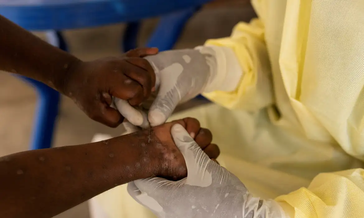 FILE PHOTO: Christian Musema, a laboratory nurse, takes a sample from a child declared a suspected case of Mpox  at the treatment centre in Munigi, following Mpox cases in Nyiragongo territory near Goma, North Kivu province, Democratic Republic of the Congo July 19, 2024. Reuters/Arlette Bashizi/Proibida reprodução