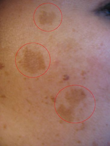 Melasma é caracterizado por manchas em tons de marrom que aparecem no rosto, mas também podem surgir em áreas, como colo e braços.