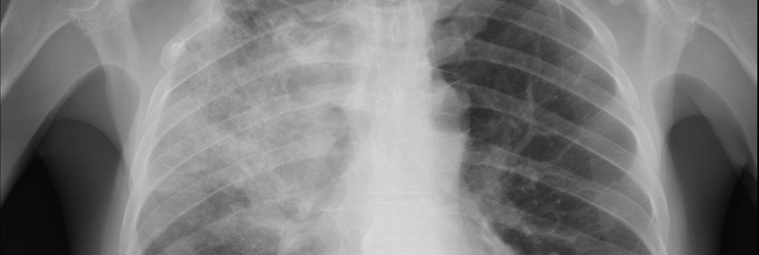 Radiografia de pulmão diagnosticado com pneumonia.