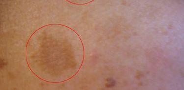 Melasma é caracterizado por manchas em tons de marrom que aparecem no rosto, mas também podem surgir em áreas, como colo e braços.