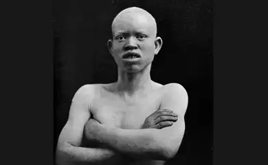 Brasília (DF) 13/06/2024 - Albino -Legenda original - Zulu Albino. A monograph on Albinism in man by
Karl Pearson and C. H. Usher. London: 1911. Plate
AA, fig. 86.
Published:  - 
Foto: @wellcome.ac.uk/WikImedia Commons