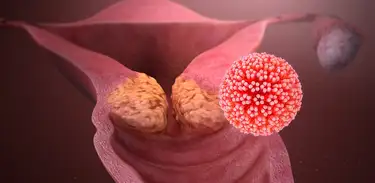 Vírus HPV pode causar câncer do colo do útero