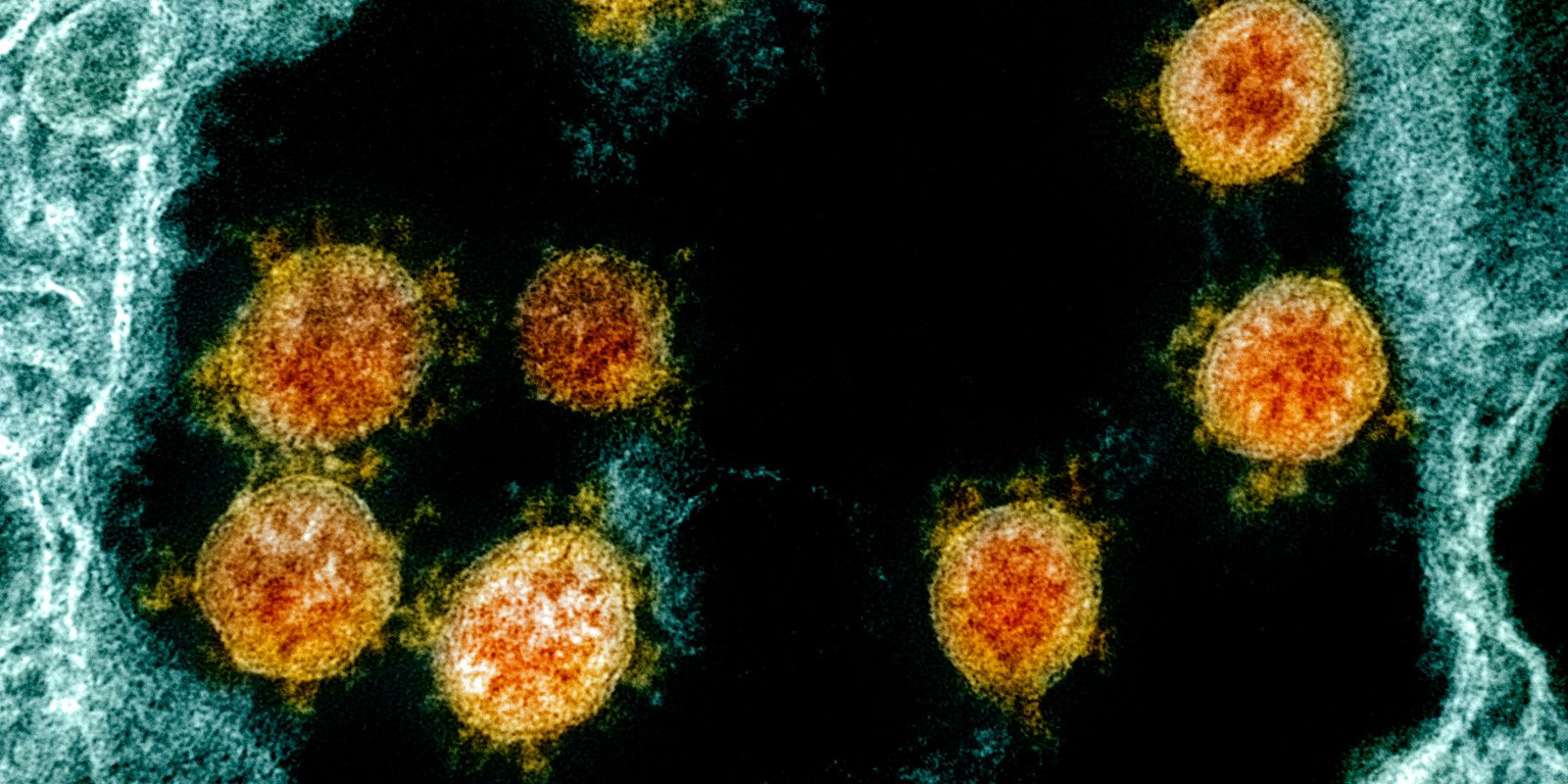 Vucruz und Harvard Erklärung der übermäßigen Entzündung des COVID-19-Virus