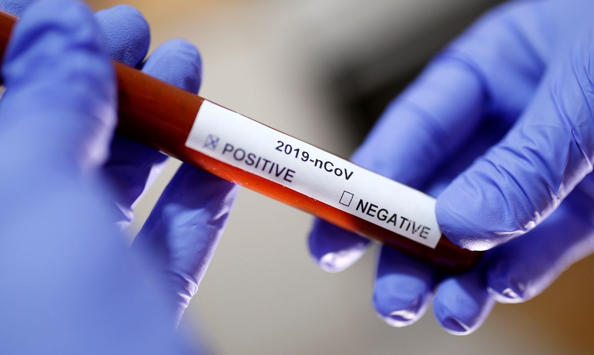 Teste de laboratório mostra resultado positivo para novo coronavírus Covid-19