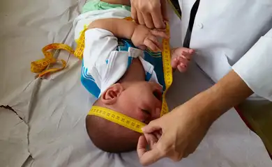 Bebê com microcefalia
